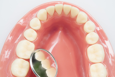 orthodontic model and dentist tool - demonstration teeth model of varities of orthodontic bracket or braceの写真素材