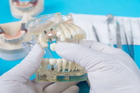 implant and orthodontic model for student to learning teaching model showing teeth.