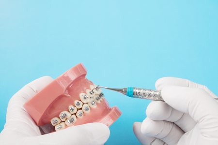 orthodontic model and dentist tool - demonstration teeth model of varities of orthodontic bracket or braceの写真素材