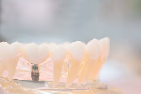 implant and orthodontic model for student to learning teaching model showing teeth.の写真素材