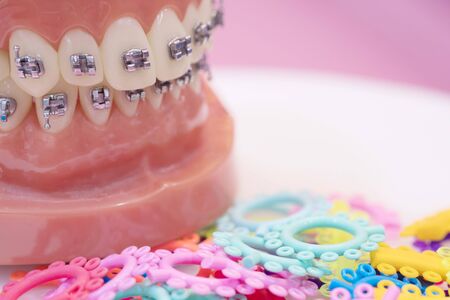 orthodontic model and dentist tool - demonstration teeth model of varities of orthodontic bracket or braceの写真素材