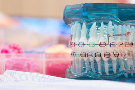 orthodontic model and dentist tool - demonstration teeth model of varities of orthodontic bracket or braceの写真素材