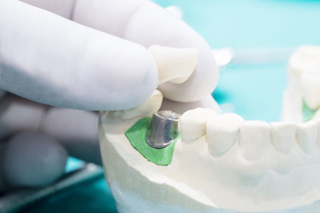 Implan model tooth support fix bridge implan and crown.の写真素材