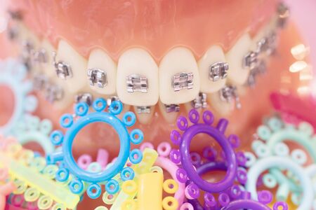 orthodontic model and dentist tool - demonstration teeth model of varities of orthodontic bracket or braceの写真素材