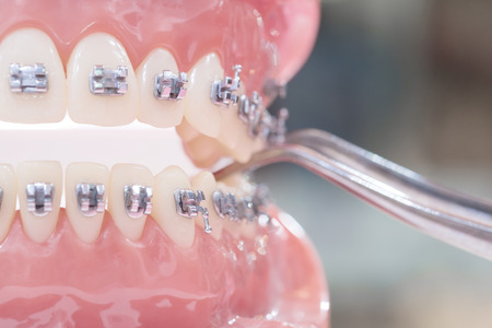 orthodontic model and dentist tool - demonstration teeth model of varities of orthodontic bracket or braceの写真素材
