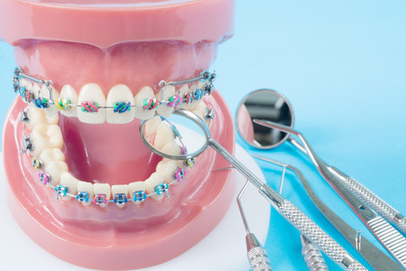 orthodontic model and dentist tool - demonstration teeth model of varities of orthodontic bracket or braceの写真素材