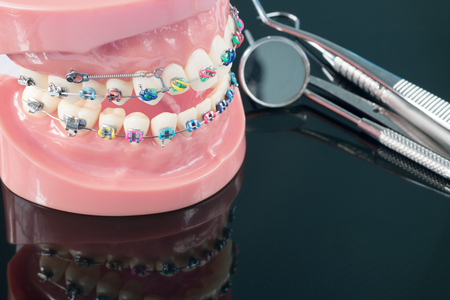 orthodontic model and dentist tool - demonstration teeth model of varities of orthodontic bracket or braceの写真素材