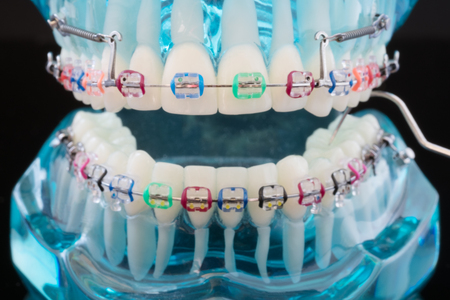 orthodontic model and dentist tool - demonstration teeth model of varities of orthodontic bracket or braceの写真素材