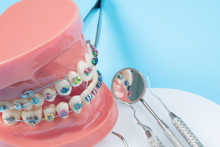 orthodontic model and dentist tool - demonstration teeth model of varities of orthodontic bracket or braceの写真素材