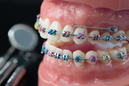 orthodontic model and dentist tool - demonstration teeth model of varities of orthodontic bracket or braceの写真素材
