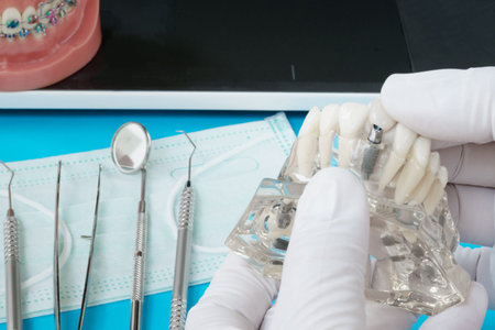implant and orthodontic model for student to learning teaching model showing teeth.