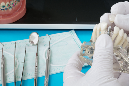 implant and orthodontic model for student to learning teaching model showing teeth.の写真素材