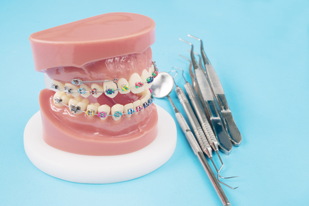 orthodontic model and dentist tool - demonstration teeth model of varities of orthodontic bracket or braceの写真素材
