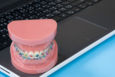 orthodontic model and dentist tool - demonstration teeth model of varities of orthodontic bracket or braceの写真素材