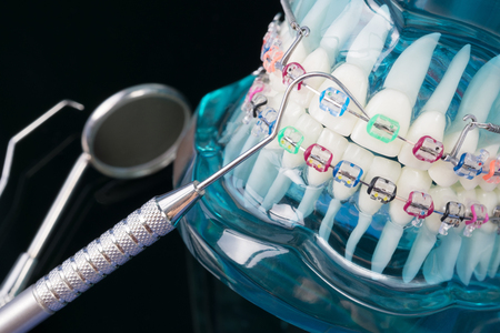 orthodontic model and dentist tool - demonstration teeth model of varities of orthodontic bracket or braceの写真素材