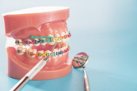 orthodontic model and dentist tool - demonstration teeth model of varities of orthodontic bracket or braceの写真素材