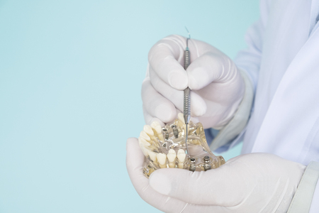 implant and orthodontic model for student to learning teaching model showing teeth.の写真素材