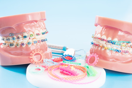 orthodontic model and dentist tool - demonstration teeth model of varities of orthodontic bracket or braceの写真素材