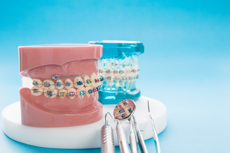 orthodontic model and dentist tool - demonstration teeth model of varities of orthodontic bracket or braceの写真素材