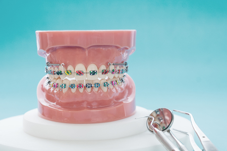 orthodontic model and dentist tool - demonstration teeth model of varities of orthodontic bracket or braceの写真素材
