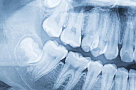 panoramic dental x-ray of a mouth left and right side.の写真素材