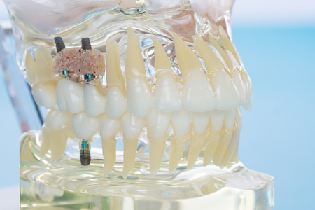 implant and orthodontic model for student to learning teaching model showing teeth.の写真素材