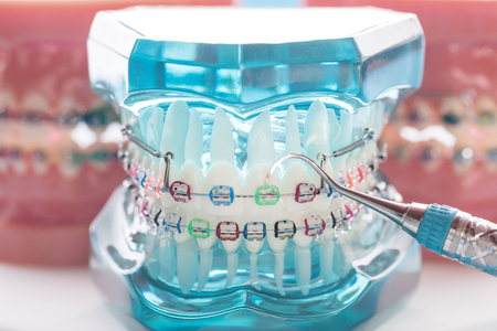 orthodontic model and dentist tool - demonstration teeth model of varities of orthodontic bracket or braceの写真素材