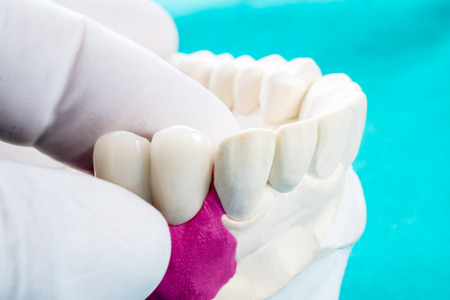 Close up Implan model tooth support fix bridge implan and crown.の写真素材