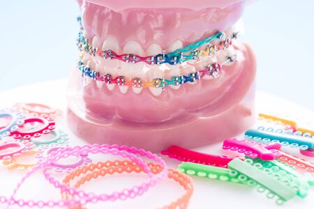 orthodontic model and dentist tool, demonstration teeth model of varieties of orthodontic bracket or braceの写真素材