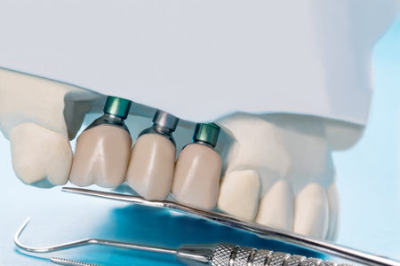 Close up Implant model tooth supported fixed bridge implant and crown.