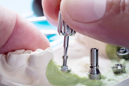 Closeup/ Convertible abutment components/ Dental implant temporary abutment/ Abutment screw.の写真素材