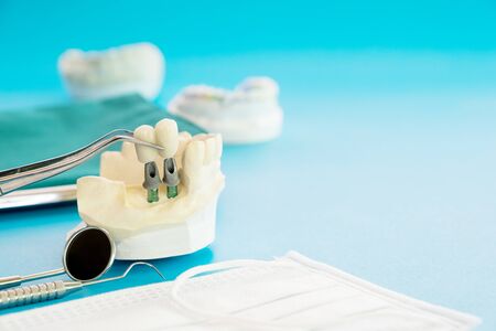 Implant model tooth support fix bridge implan and crown.の写真素材