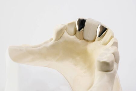 Closeup / Dental maryland bridge / Crown and bridge equipment and model express fix restoration.の写真素材