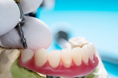 Closeup/ Dental implants supported overdenture on blue background/ Screw retained/ implant restorations.の写真素材
