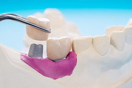 Closeup / Implant Prosthodontics or Prosthetic / Tooth crown and bridge implant dentistry equipment...