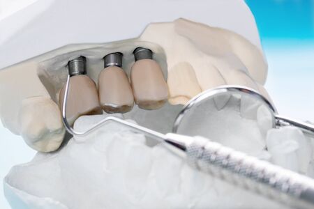 Close up Implant model tooth support fix bridge implant and crown.の写真素材