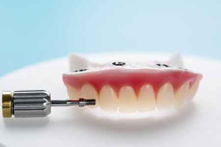 Closeup/ Dental implants supported overdenture on blue background/ Screw retained/ implant...