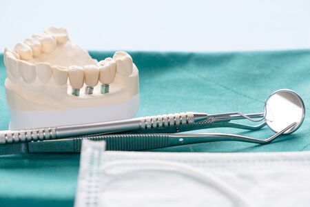 Close up Implant model tooth support fix bridge implant and crown.の写真素材