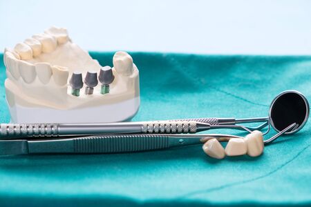 Close up Implant model tooth support fix bridge implant and crown.の写真素材