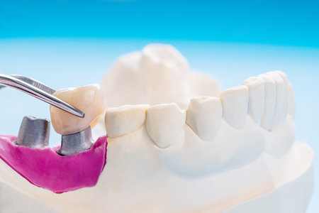 Closeup / Implant Prosthodontics or Prosthetic / Tooth crown and bridge implant dentistry equipment...