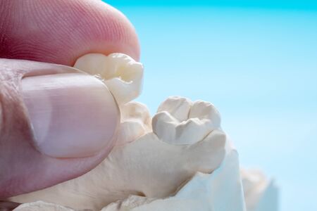 Closeup Prosthetic teeth crown and bridge equipment model express fix restoration.の写真素材