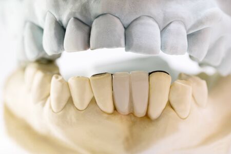 Closeup / Dental maryland bridge / Crown and bridge equipment and model express fix restoration.の写真素材