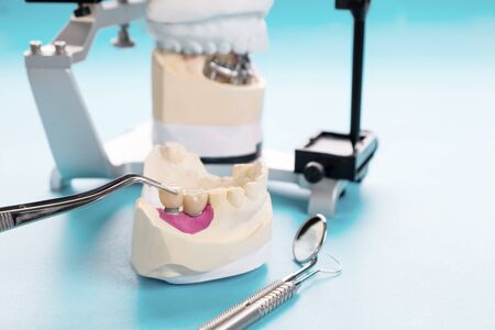 Implant Prosthodontics or Prosthetic / Tooth crown and bridge implant dentistry equipment and model express fix restoration.の写真素材