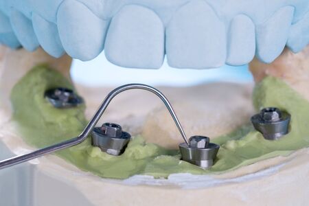 Closeup/ Convertible abutment components/ Dental implant temporary abutment/ Abutment screw implant.の写真素材