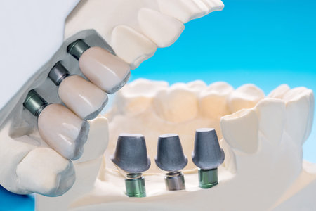 Close up Implant model tooth support fix bridge implant and crown.