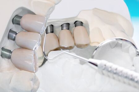 Close up Implant model tooth support fix bridge implant and crown.の写真素材