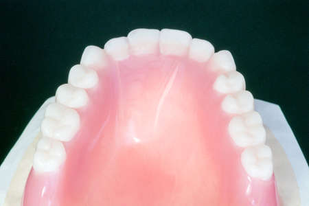orthodontic model and dentist tool - demonstration teeth model of varities of orthodontic bracket or braceの写真素材