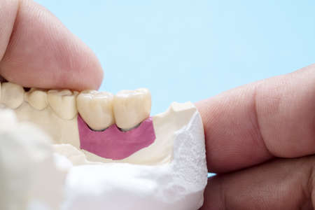 Closeup / Implant Prosthodontics or Prosthetic / Tooth crown and bridge implant dentistry equipment and model express fix restoration.の写真素材