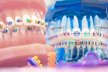 orthodontic model and dentist tool - demonstration teeth model of varities of orthodontic bracket or...