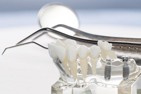 implant and orthodontic model for student to learning teaching model showing teeth.